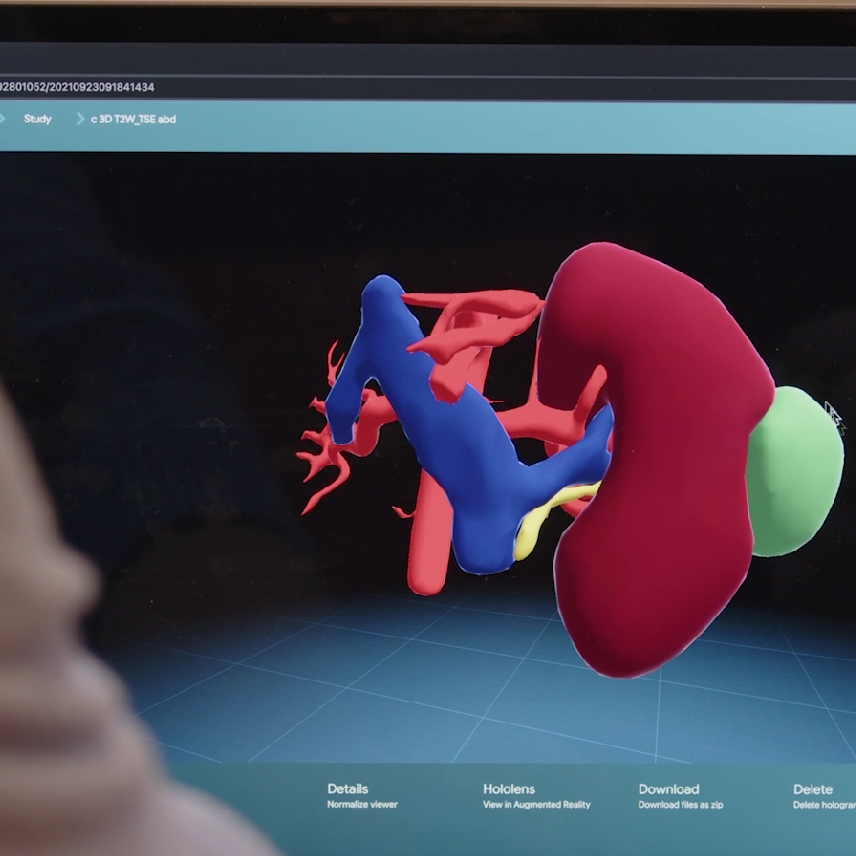 Innovative 3D model supports surgeons in operations for children with kidney cancer